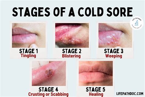 photos of cold sore stages|cold sore inside lip pictures.